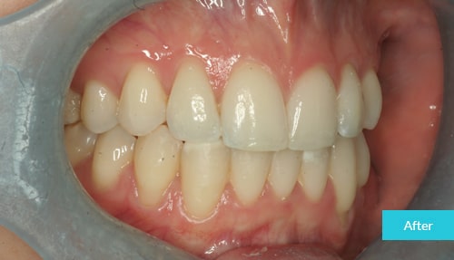  Invisalign case After 20