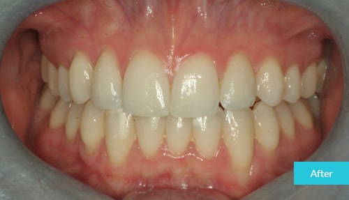  Invisalign case After 21