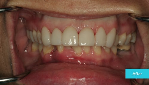 Upper veneers to better shape and alignment of teeth after