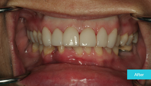 upper veneers to better shape and alignment of teeth after
