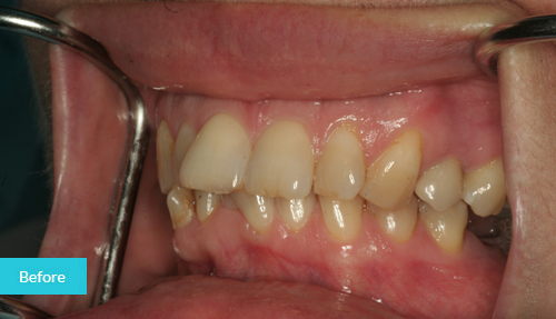 upper veneers to better shape and alignment of teeth before