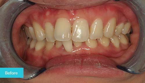 Invisalign Before Case 4 - Dental Clinic London