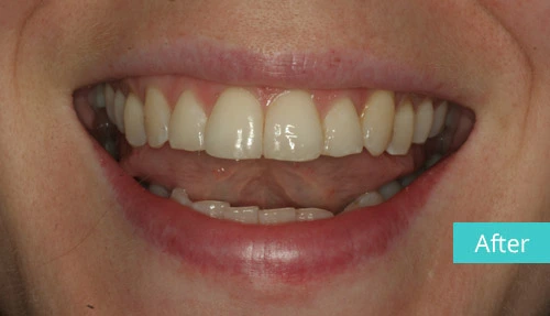 Invisalign case After 3