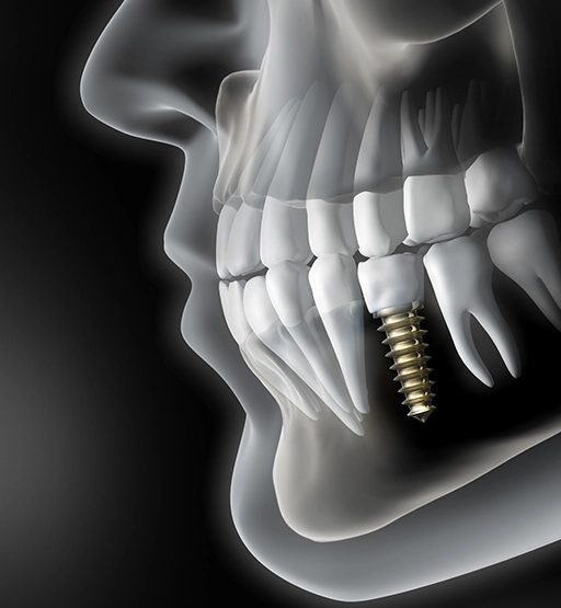 Dental Implant