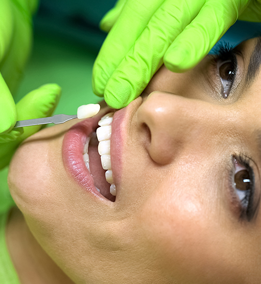 Dental Veneers treatment
