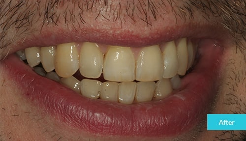 Invisalign After 8