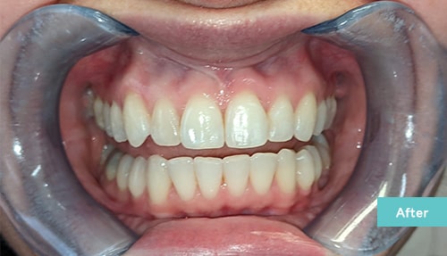 Invisalign and Contouring after 1