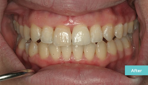 Invisalign and Contouring after 2