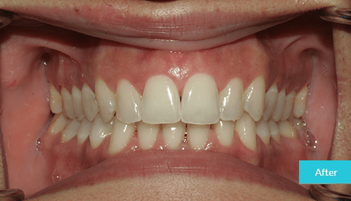 invisalign and teeth whitening After