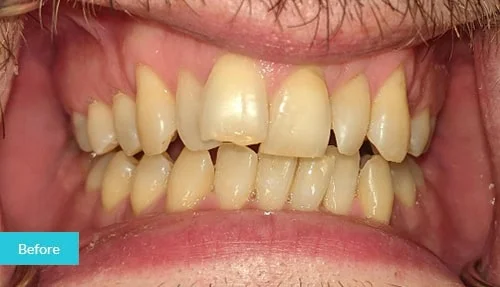 Invisalign Before 8