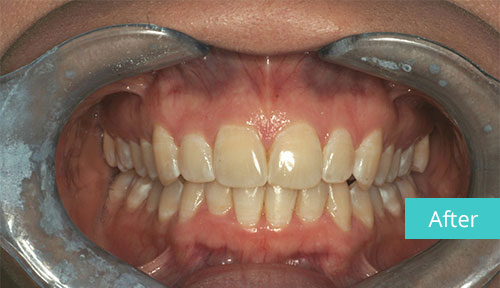 Invisalign case After 7