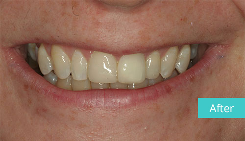Invisalign Case after 8