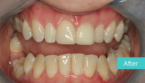 Invisalign Case after 9