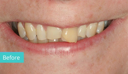 Invisalign Case Before 8 