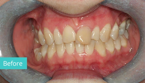 Invisalign Case before 9