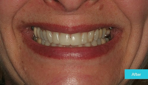 Invisalign and Bonding after 2