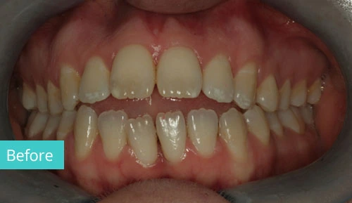 Invisalign Case before 13 