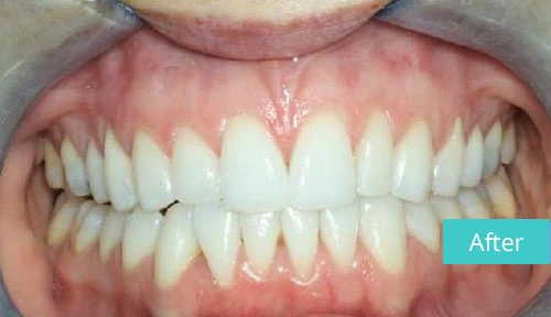 Invisalign Case After 10