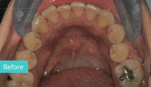 Invisalign Case before 14