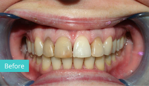 Invisalign Case Before 4