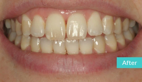 Invisalign Case After 13