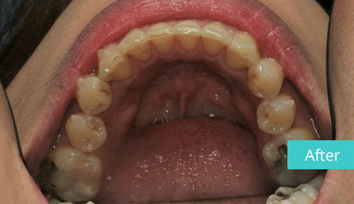 Invisalign case After 14