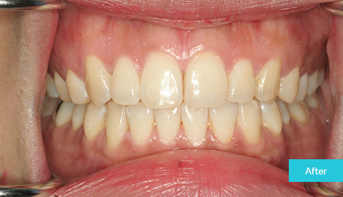Invisalign Case After