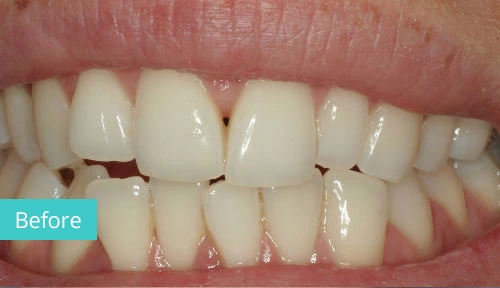 Invisalign Case Before 10