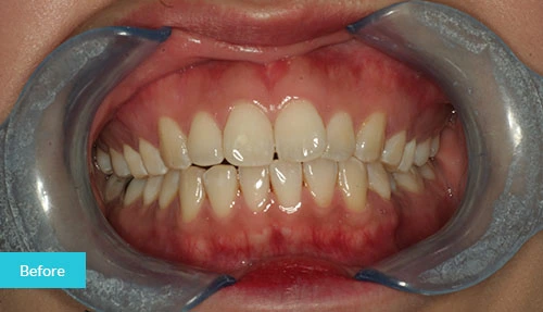 Invisalign Case Before