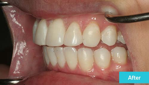 Invisalign Lite, Teeth Whitening and Dental Bonding After 1