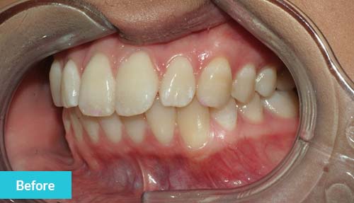 Invisalign Lite, Teeth Whitening and Dental Bonding Before 1