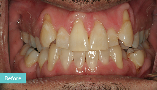 gap teeth before invisalign