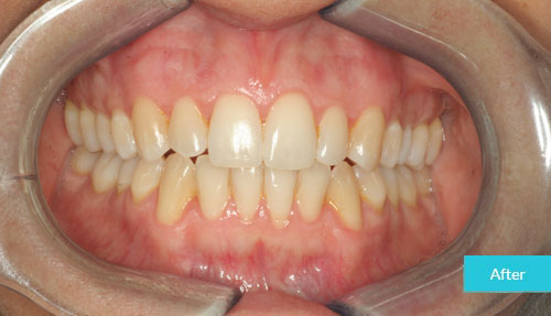Invisalign after 3