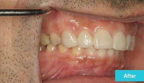 Teeth Reconstruction After 2