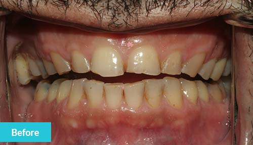 Teeth Reconstruction Before 1