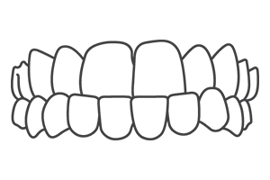 underbite – Dental Clinic