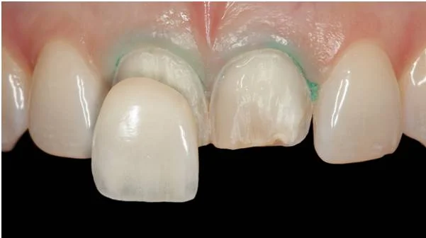 Dental veneers before 2