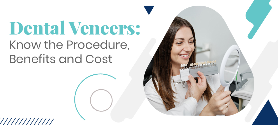 Dental Veneers: Know the Procedure, Benefits and Cost