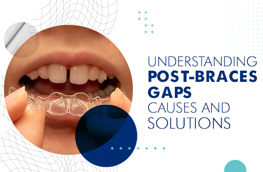 Understanding Post - Braces Gaps: Causes and Solutions