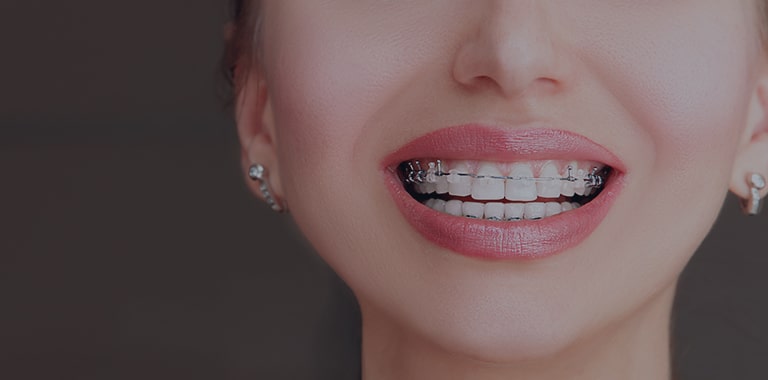 Ceramic Braces London, Clear Ceramic Braces offers